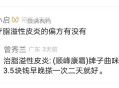 治疗脂溢性皮炎的偏方有没有或者什么要好用