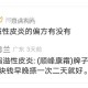 治疗脂溢性皮炎的偏方有没有或者什么要好用