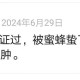 用丝瓜水治被蜜蜂蛰神奇的方法